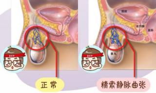 精索静脉曲张有什么症状呢 精索静脉曲张症状图